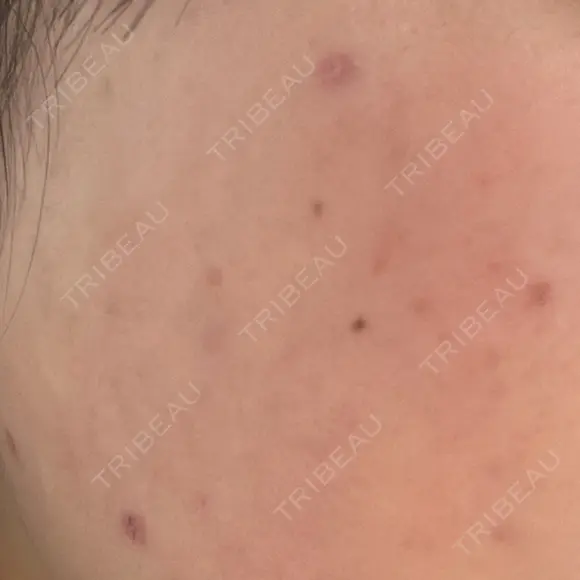 ほくろ・いぼ除去レーザー（肌） 心斎橋KT美容クリニック AFTER メイン用