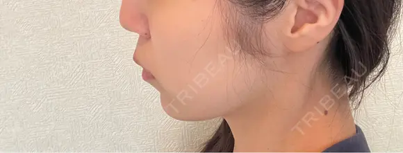 インモード TUNE CLINIC【チューンクリニック】 DAY 3 メイン用