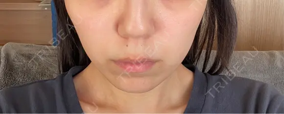 インモード TUNE CLINIC【チューンクリニック】 DAY 3 メイン用