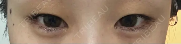 ヒアルロン酸注入（涙袋） フィラークリニック 大阪心斎橋院 DAY 1 メイン用