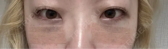 クマ治療 / 下まぶたたるみ取り / 下まぶたの脂肪取り / ヒアルロン酸注入（目の下） / スネコス 新宿美容外科ネビュラクリニック DAY 0 メイン用