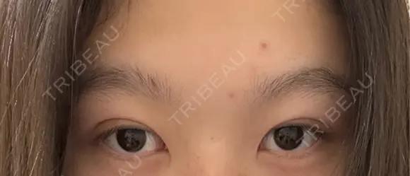 二重埋没 湘南美容クリニック 千葉センシティ院 DAY 0 メイン用