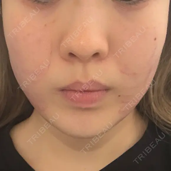 その他（肌） / インモード 東京美容皮膚科アロエクリニック池袋 DAY 0 メイン用