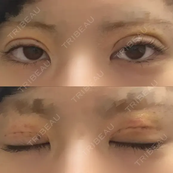 二重埋没 形成外科と美容外科のクリニック池袋 DAY 3 メイン用