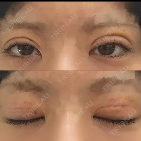 二重埋没 形成外科と美容外科のクリニック池袋 DAY 4 メイン用