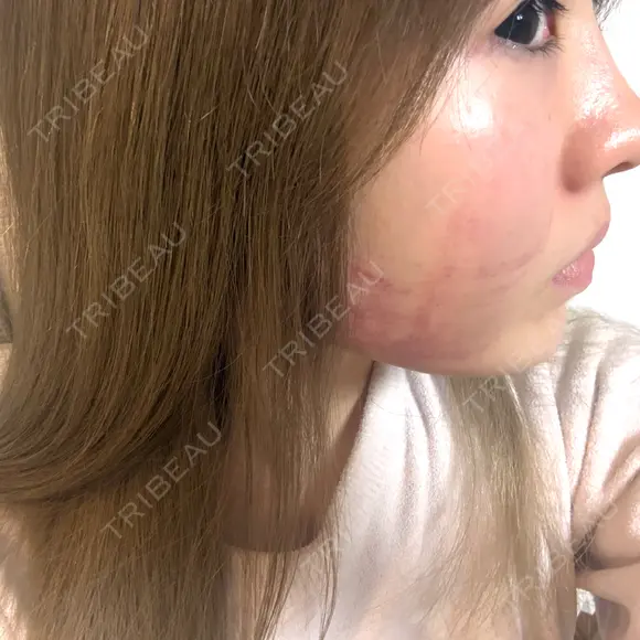 その他（肌） / インモード 東京美容皮膚科アロエクリニック池袋 DAY 0 メイン用