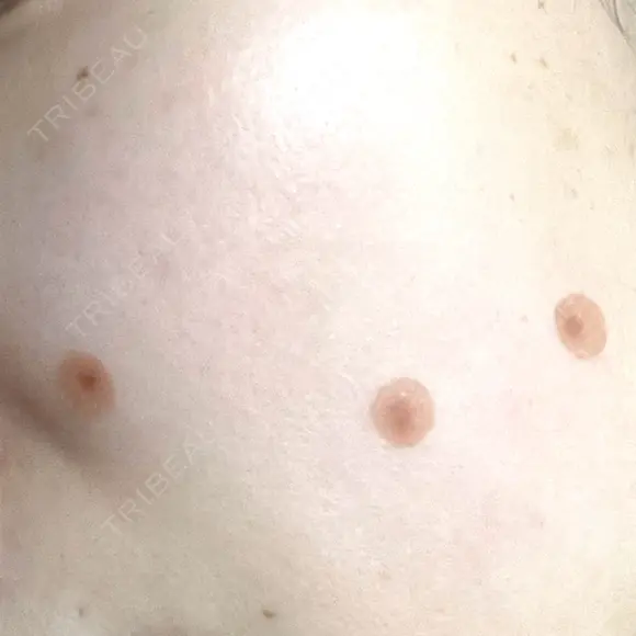 ほくろ・いぼ切除（肌） フローラクリニック DAY 7 メイン用