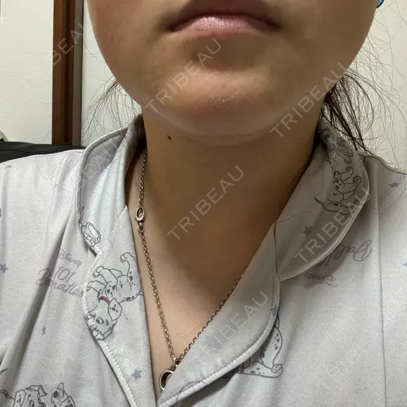 脂肪溶解注射（顔） ルラ美容クリニック 横浜院 DAY 4 メイン用