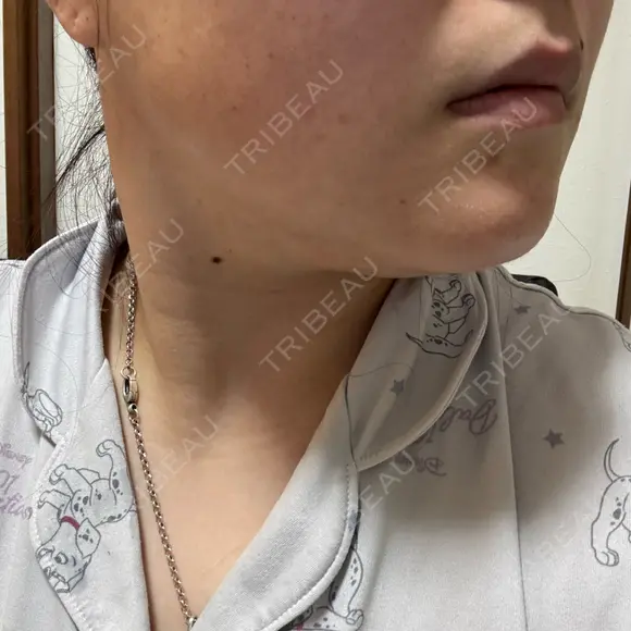 脂肪溶解注射（顔） ルラ美容クリニック 横浜院 DAY 4 メイン用