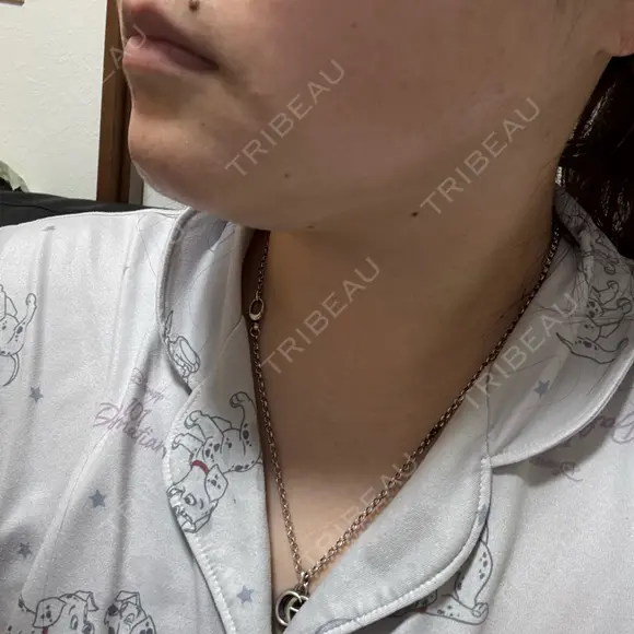 脂肪溶解注射（顔） ルラ美容クリニック 横浜院 DAY 4 メイン用