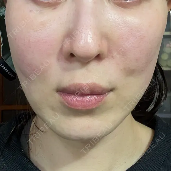 スネコス ミニマムスキンクリニック池袋 DAY 1 メイン用