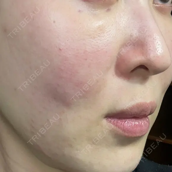 スネコス ミニマムスキンクリニック池袋 DAY 1 メイン用