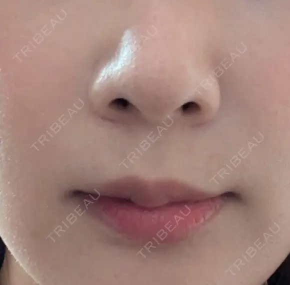 真皮移植 / 鼻翼基部形成（貴族手術） EMMO FACE CLINIC 東京三田院 DAY 7 メイン用