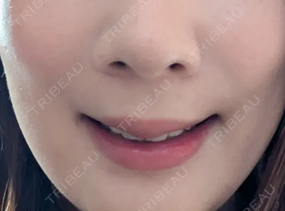 真皮移植 / 鼻翼基部形成（貴族手術） EMMO FACE CLINIC 東京三田院 DAY 7 メイン用