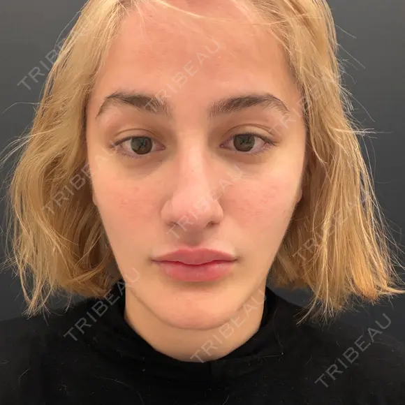 糸リフト A CLINIC（エークリニック） 横浜院 AFTER メイン用