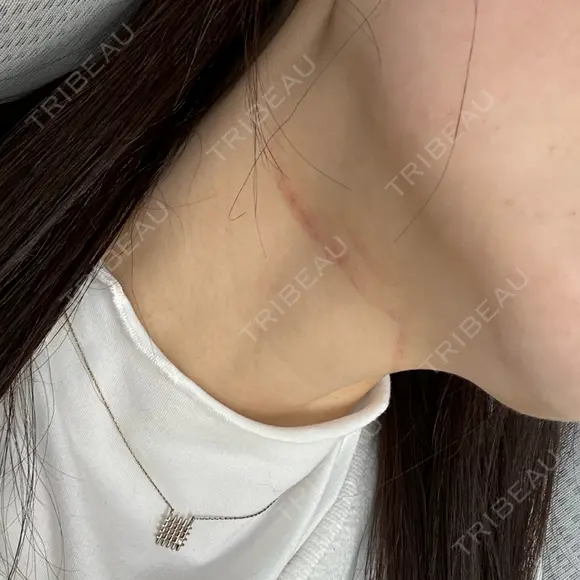 ボトックス（エラ・小顔） / RF（高周波）たるみ治療 大美会クリニック 梅田院 DAY 4 メイン用