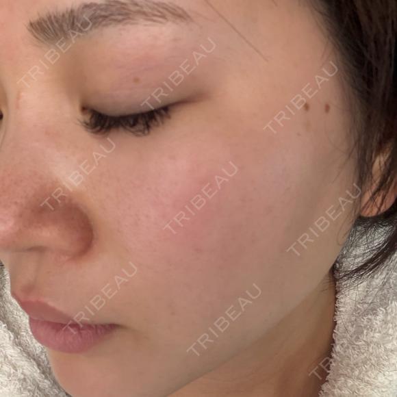 ルメッカ BITO BEAUTY CLINIC DAY 6 メイン用