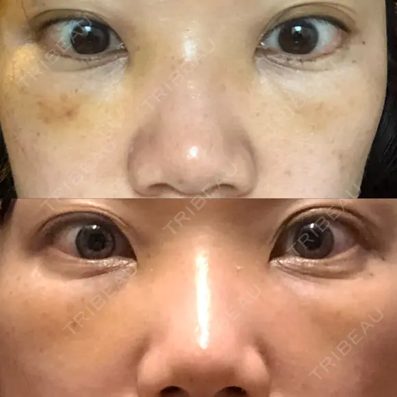 下まぶたたるみ取り セオリークリニック DAY 4 メイン用