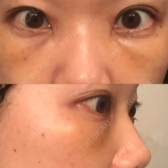 下まぶたたるみ取り セオリークリニック DAY 6 メイン用