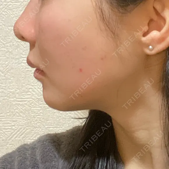 ヒアルロン酸注入（頬） / ヒアルロン酸注入（鼻翼基部） KIMI CLINIC 形成・美容外科 DAY 11 メイン用