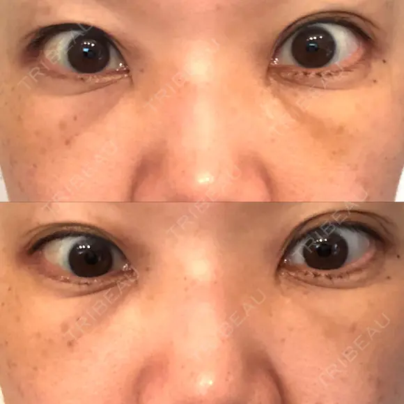 下まぶたたるみ取り セオリークリニック DAY 7 メイン用