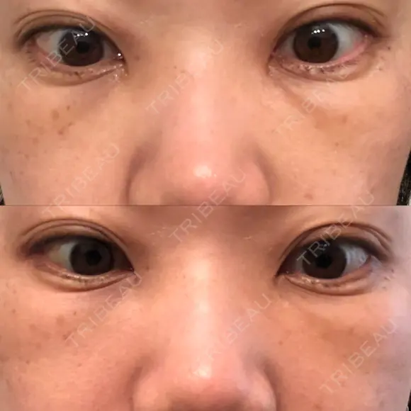 下まぶたたるみ取り セオリークリニック DAY 8 メイン用