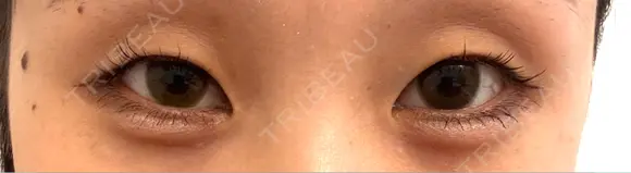 ヒアルロン酸注入（涙袋） フィラークリニック 大阪心斎橋院 AFTER メイン用