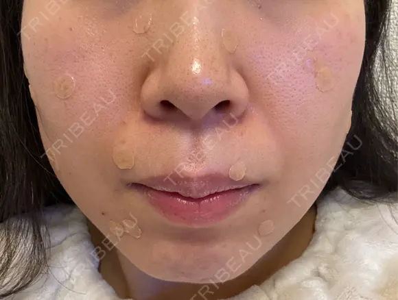 ほくろ・いぼ除去レーザー（肌） Fellez Clinic【フェルズクリニック】 AFTER メイン用