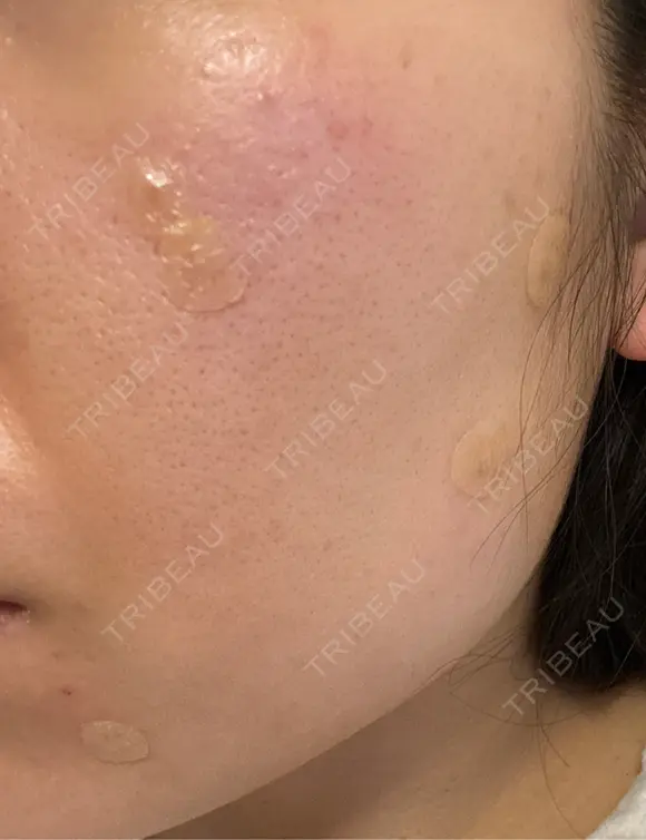 ほくろ・いぼ除去レーザー（肌） Fellez Clinic【フェルズクリニック】 DAY 0 メイン用