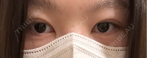 二重埋没 湘南美容クリニック 千葉センシティ院 DAY 1 メイン用