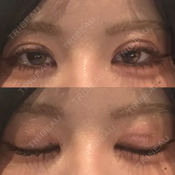 二重埋没 形成外科と美容外科のクリニック池袋 DAY 5 メイン用