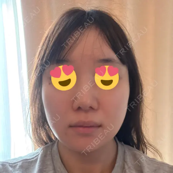 デンシティ DAILY SKIN CLINIC 新宿院 AFTER メイン用