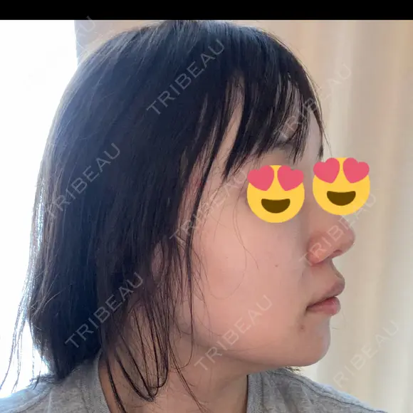 デンシティ DAILY SKIN CLINIC 新宿院 DAY 7 メイン用