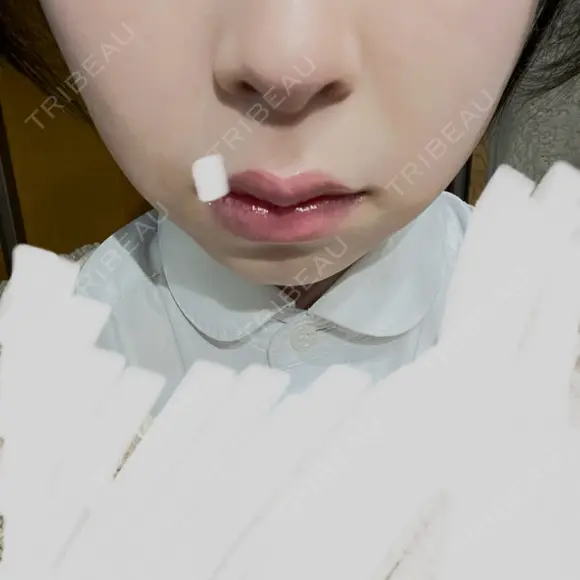 ハイフ（顔） 表参道メディカルクリニック 名古屋院 DAY 13 メイン用