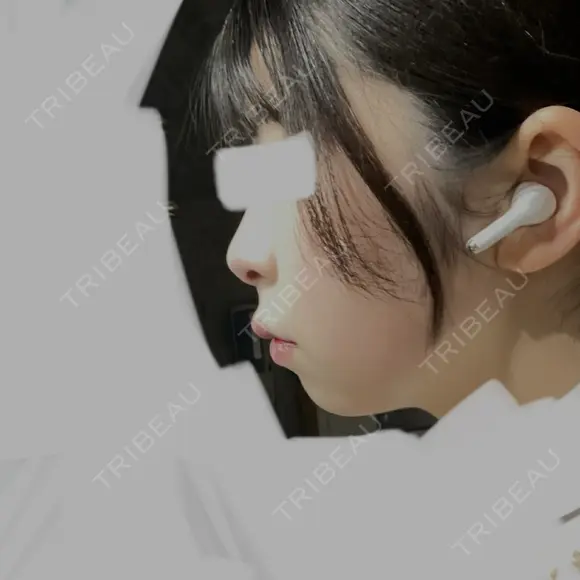 ハイフ（顔） 表参道メディカルクリニック 名古屋院 DAY 13 メイン用