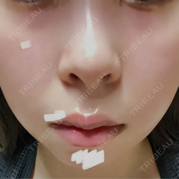 ハイフ（顔） 表参道メディカルクリニック 名古屋院 DAY 15 メイン用