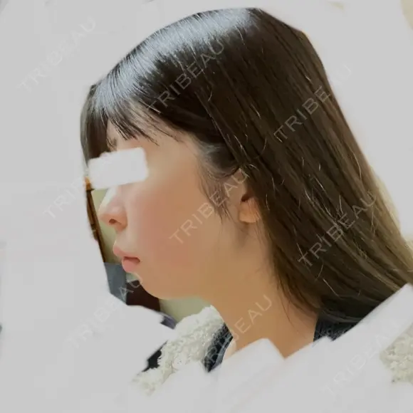 ハイフ（顔） 表参道メディカルクリニック 名古屋院 DAY 15 メイン用