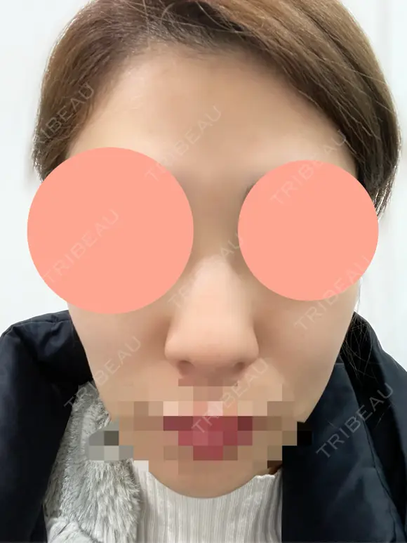 ヒアルロン酸注入（鼻） 博多美容外科/美容皮膚科 ビラビューティークリニック AFTER メイン用