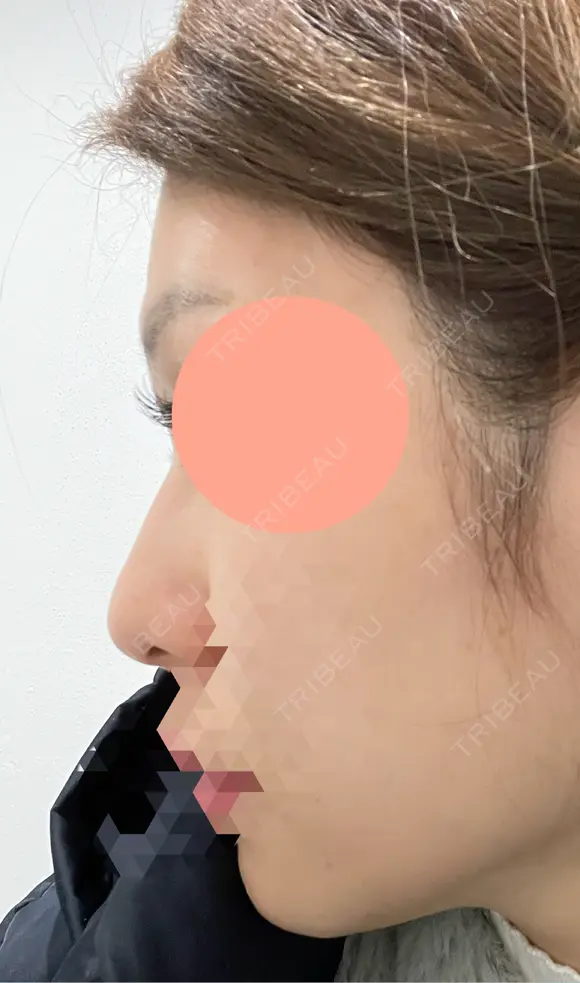 ヒアルロン酸注入（鼻） 博多美容外科/美容皮膚科 ビラビューティークリニック DAY 8 メイン用