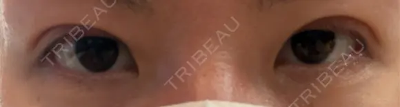 二重埋没 湘南美容クリニック 千葉センシティ院 DAY 8 メイン用