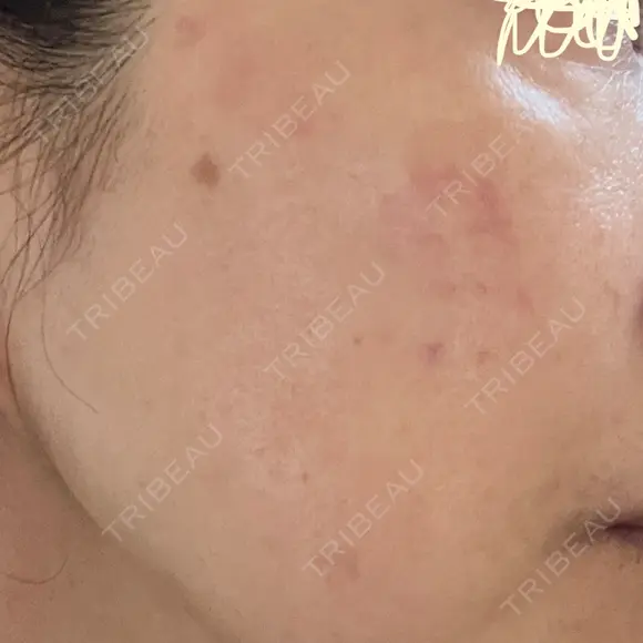 プラセンタ注射 / シミ取りレーザー S-Laboクリニック 渋谷院 DAY 9 メイン用