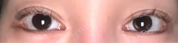 目尻切開 / タレ目形成・グラマラスライン（埋没） LOUIS CLINIC 二子玉川院【ルイクリニック】 DAY 10 メイン用