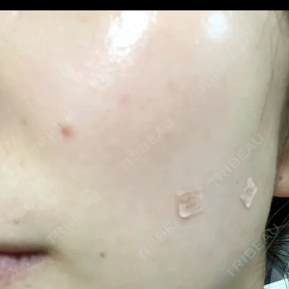 ほくろ・いぼ切除（肌） フローラクリニック DAY 9 メイン用