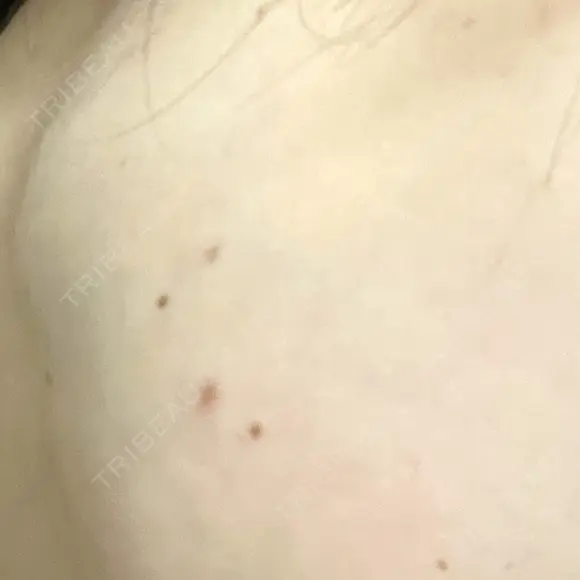 ほくろ・いぼ切除（肌） フローラクリニック DAY 9 メイン用