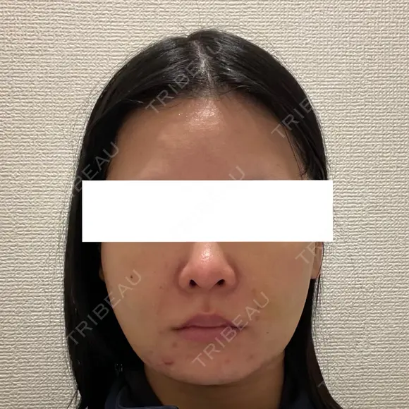 脂肪吸引（顔） ルラ美容クリニック 新宿院 DAY 7 メイン用