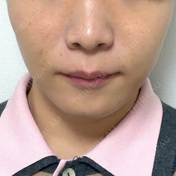 糸リフト / バッカルファット除去 / 脂肪吸引（顔） / メーラーファット除去 / ジョールファット除去 / その他（輪郭） First Clinic AFTER メイン用