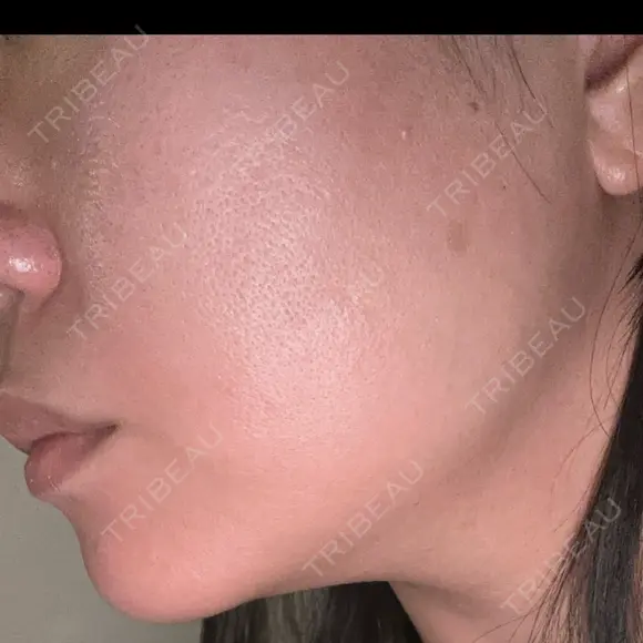 ハイフ（顔） A CLINIC（エークリニック） 新宿院 AFTER メイン用