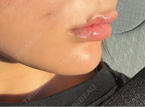 ヒアルロン酸注入（あご） 千葉美容外科アイビークリニック AFTER メイン用