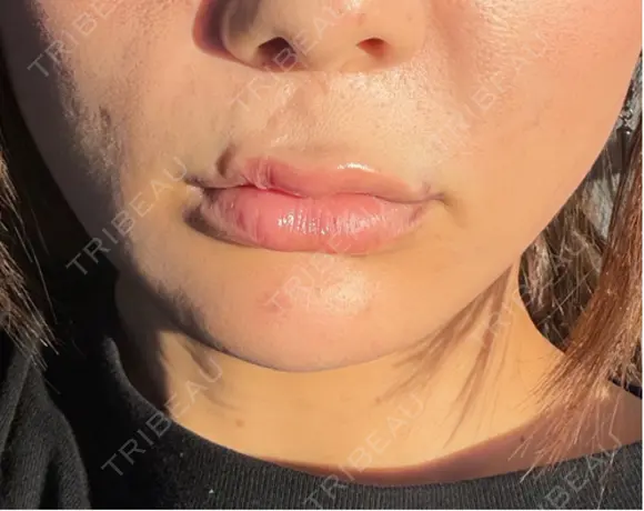 ヒアルロン酸注入（あご） 千葉美容外科アイビークリニック DAY 18 メイン用