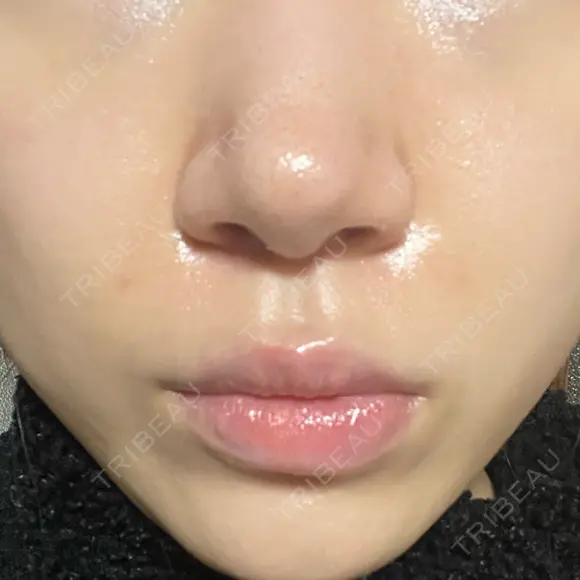 ボトックス（口角） / ヒアルロン酸注入（鼻翼基部） ルラ美容クリニック 大阪本院 DAY 2 メイン用